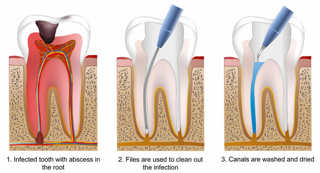 Root canal treatment